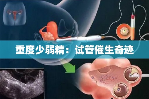 重度少弱精:试管催生奇迹 重度少弱精:试管催生奇迹