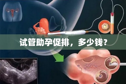 试管助孕促排，多少钱？