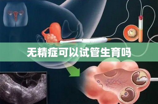 无精症可以试管生育吗